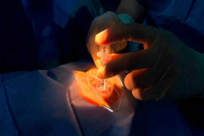 As mãos enluvadas do oftalmologista Dr. Wener Cella realizam um delicado procedimento ocular sob forte iluminação cirúrgica, injetando fluido próximo ao olho exposto e coberto por um campo cirúrgico